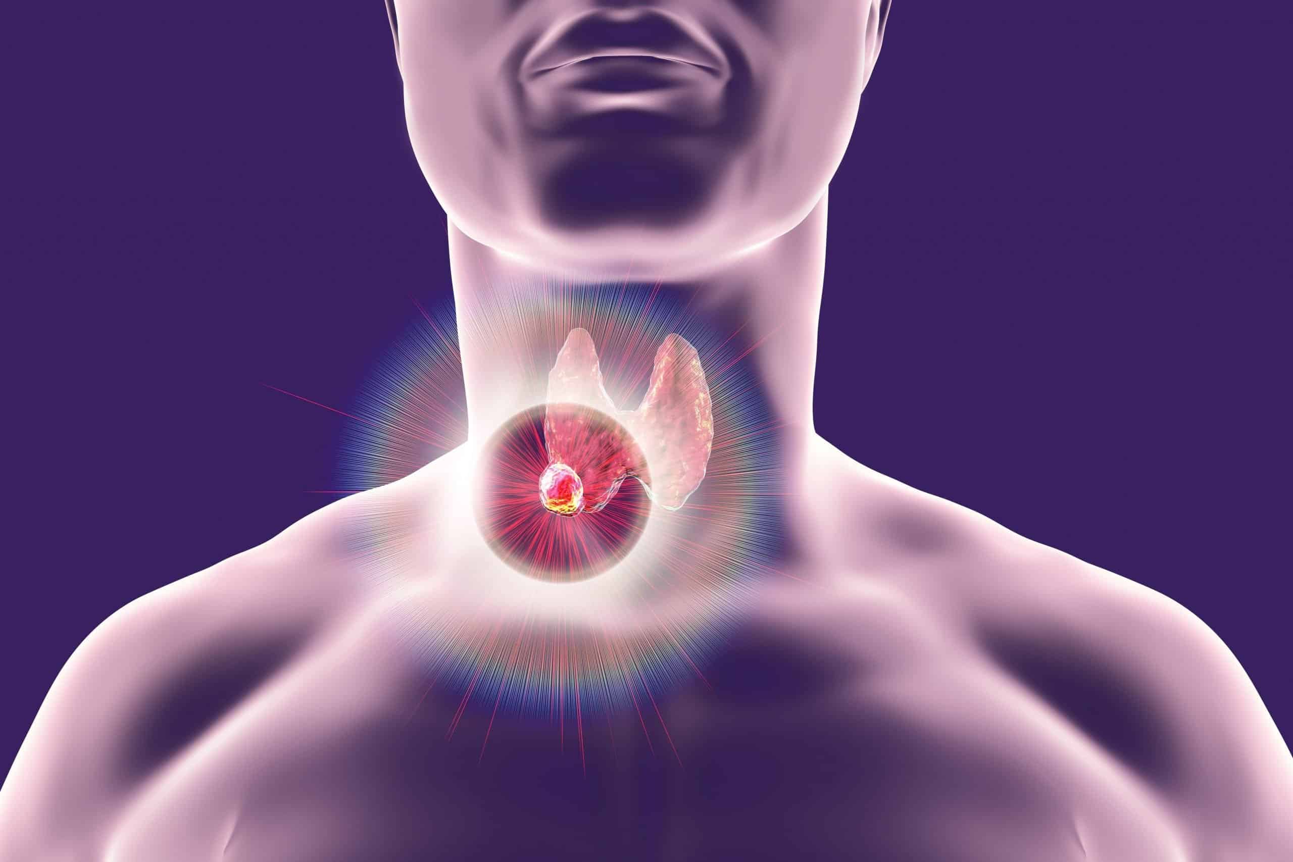 Holistic thyroid cancer treatment